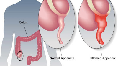 http://surgicalgastro.com/appendicitis/