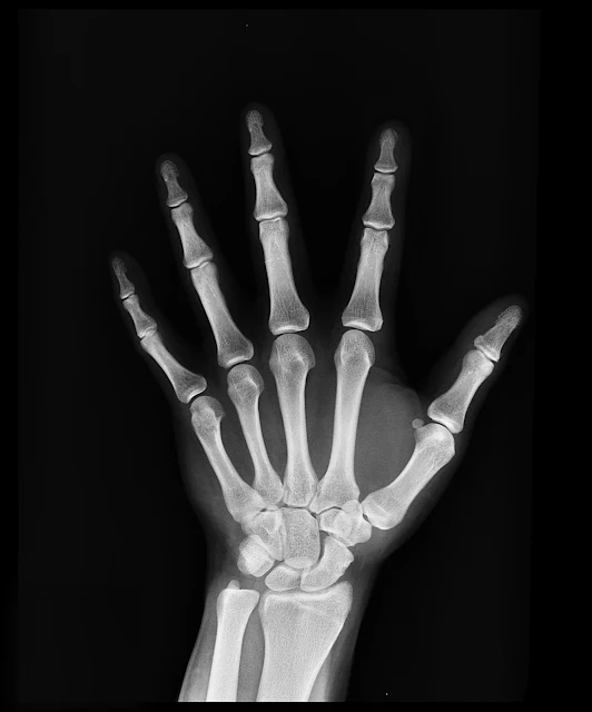 rheumatoid arthritis