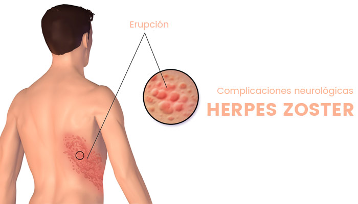komplikasi herpes zoster