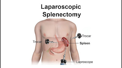 http://www.laparoscopicsolutions.in/spleen-surgery.html