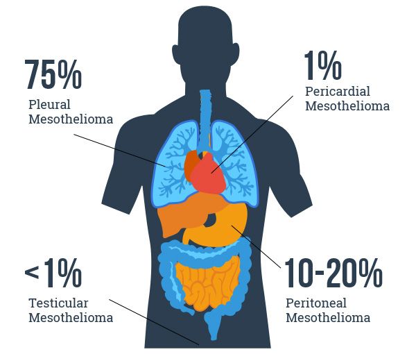 What are the different types of mesothelioma? 