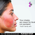 Did you know that 45-50 percent of people with psoriasis experience psoriasis on their face? 