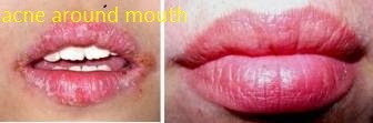 http://acnearound-mouth.blogspot.com/2013/12/acene-around-mouth.html