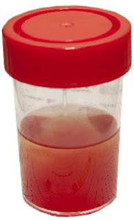 blood in urine in PKD