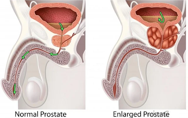 புரோஸ்டேட் பெரிதானால் ஏற்படும் விளைவுகள் !