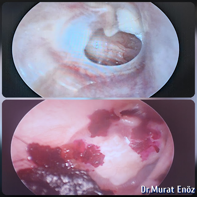 Transcanal endoscopic myringoplasty,Endoscopic eardrum repair,Endoscope assisted myringoplasty, Eardrum hole surgery