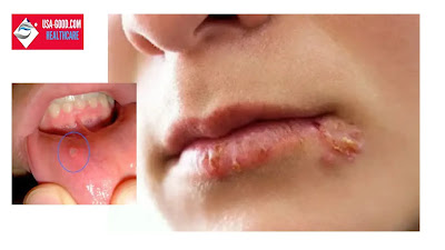 What Is Cold Sore?