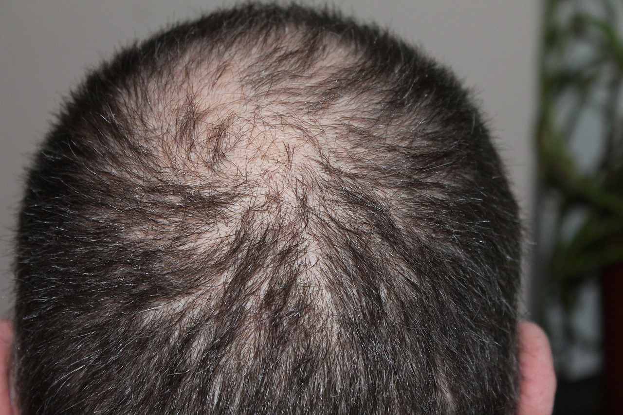 What is The Root Cause of Hair Loss
