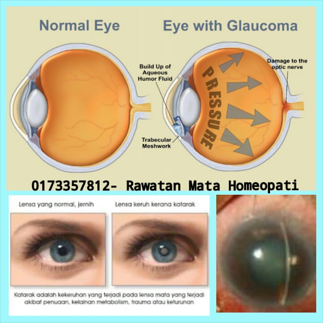 Ubat Mata Untuk Katarak - Jurupulih