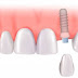 Quy trình cấy ghép răng implant an toàn hiệu quả