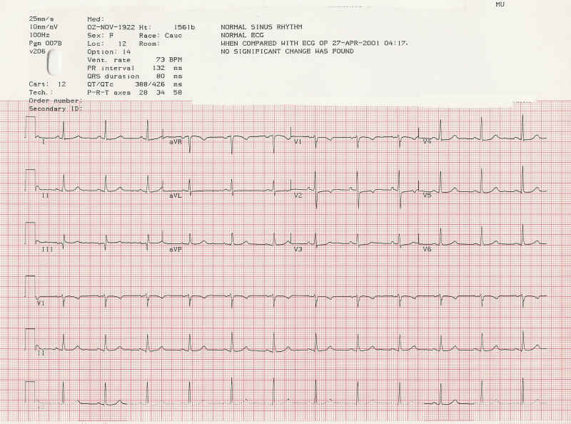 Heart disease: EKG's and heart disease