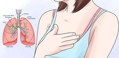 Why Heartburn, Acid Reflux And Stomach Pain Could Be Early Warning Sings Of Cancer