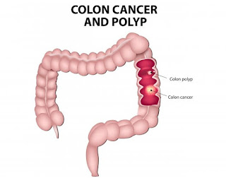 Colorectal Cancer: Causes, Symptoms and Treatments