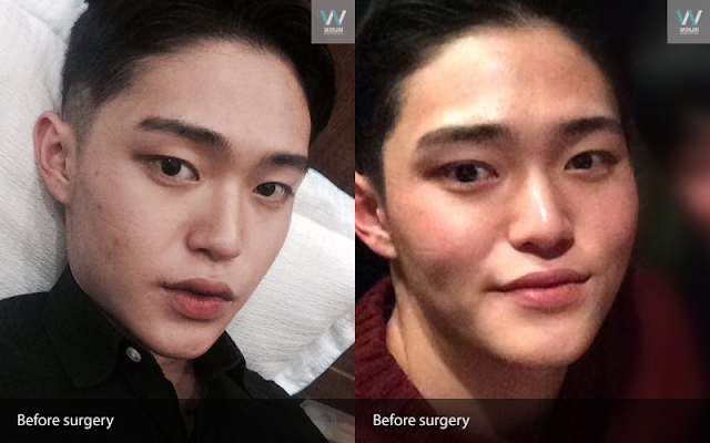 짱이뻐! - Popular Plastic Surgery Review For Male Patients