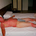10 Fucked Up Sunburns That Will Make You Fear the Summer