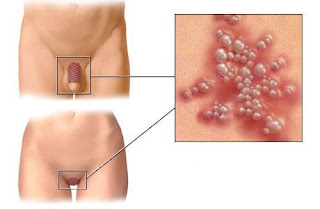 como eliminar el virus del herpes genital