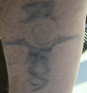 Tattoo fading after sixth picosure session