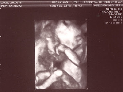 3d ultrasound pictures of twins. Picture 4: quot;This 3D ultrasound