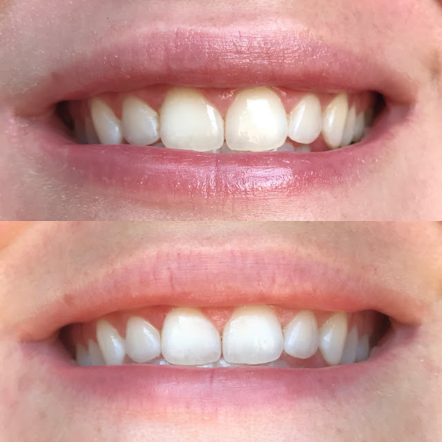 Teeth Whitening Reviews