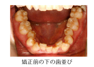 矯正の写真　©親知らずの矯正ブログ