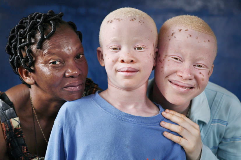 Kisah Tragis Orang Albino Hidup Bagaikan Neraka di 