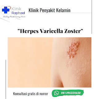 herpes simplex