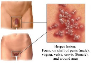 Herpes Cure 2013 Florida : How You Can Cure A Cold Sore Using Oxygen Dietary Supplements