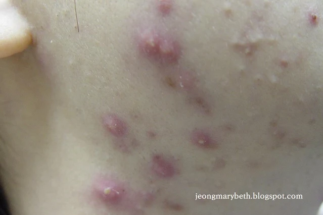 Adult acne (2) Image