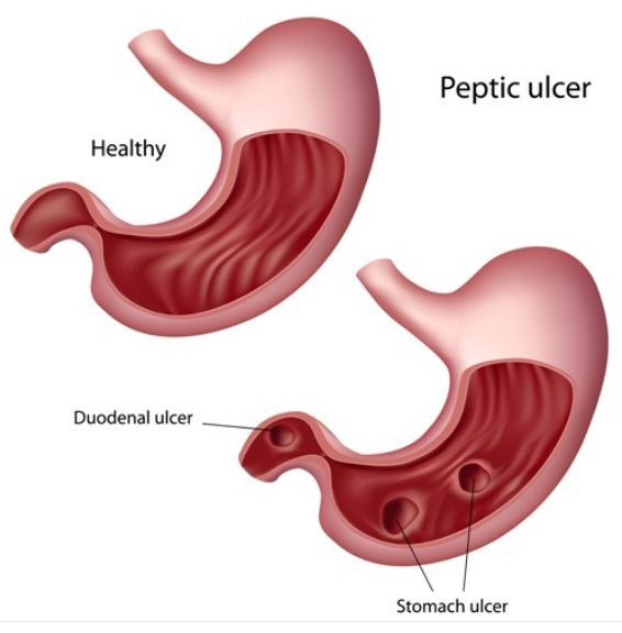 Ulcer