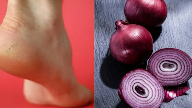 Cracked Heels Home Remedies