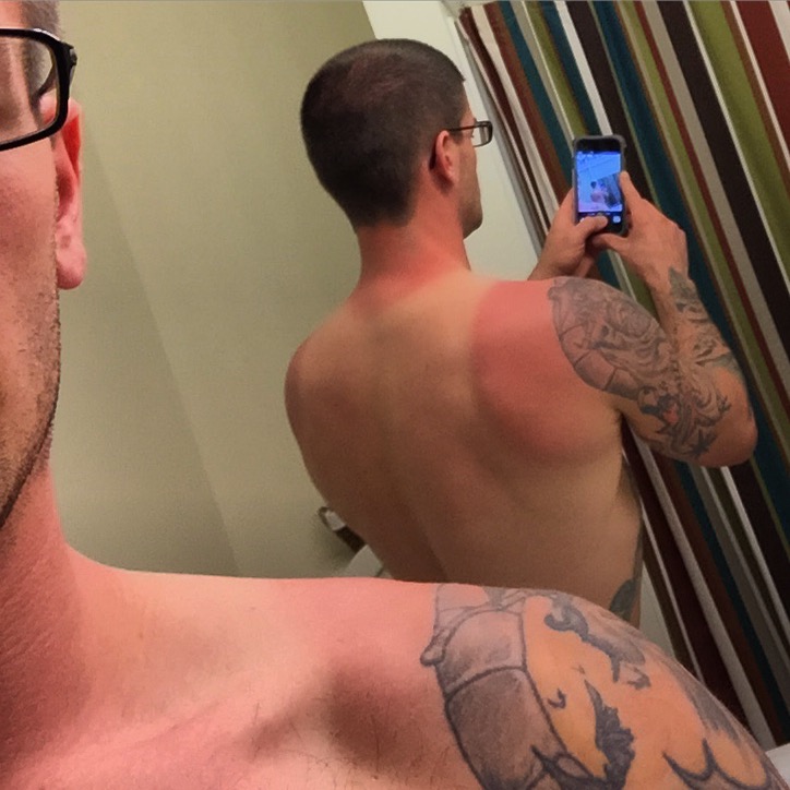 back sun burn tan line