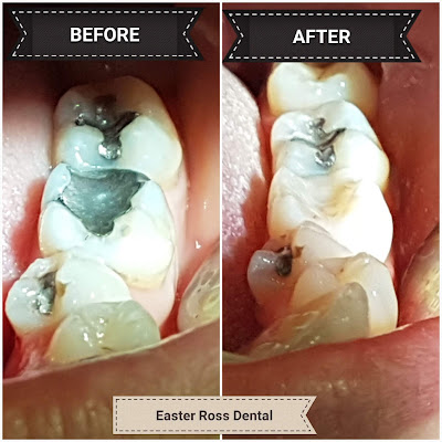 https://easterrossdental.com/tooth-abscess-treatment/