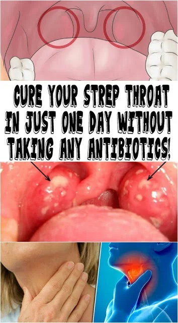 Cure Your Strep Throat In Just One Day Without Taking Any Antibiotics!