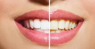 laser teeth whitening dubai