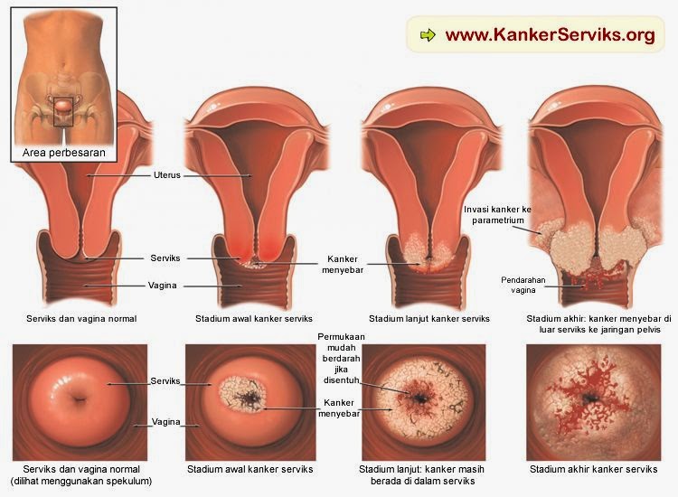 pengobatan tradisional tumor serviks, obat kanker serviks, pengobatan kanker serviks