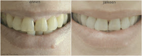 hampaidenvalkaisu, teeth whitening, swiss whitening