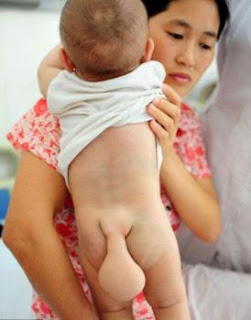 بالصور .. ولادة طفل بذيل فى جنوب الصين !!!