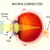 Myopia Control - A Cure For Nearsightedness?