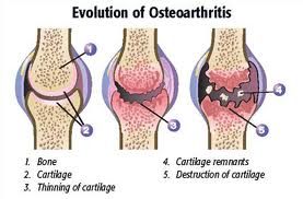 Degenerative Joint Disease