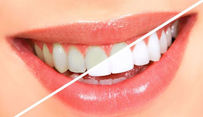 Làm thế nào để răng trắng sáng tự nhiên?