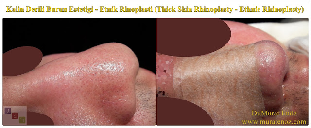 Kalın derili burun estetiği algoritması - Kalın derili rinoplasti - Thick skin rhinoplasty in İstanbul - Kalın derili burun estetiği teknikleri - Kalın derili burun estetiği nasıl yapılır? - Kalın derili burun estetiği en iyi teknik hangisidir? - Etnik burun estetiği - Ethnic rhinoplasty in nen  Istanbul - Ethnic nose job in Istanbul - Ethnic nose surgery in men Istanbul - Nose job in Turkey - Ethnic rhinoplasty in men Turkey - Ethnic rhinoplasty in Turkey - - Ethnic expert nose job surgeon - Ethnic rhinoplasty surgeon in Istanbul - Black nose job - Rhinoplasty for ethnic nose in men - Thick skin rhinoplasty - Thick skin rhinoplasty in men istanbul