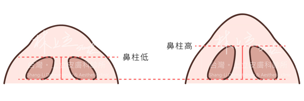 微晶瓷晶亮瓷洢蓮絲隆鼻洢蓮絲ellanse聚己內酯PCL依戀詩易麗適少女針奇蹟針洢蓮絲費用價格隆鼻上立醫師上立皮膚科診所01.jpg