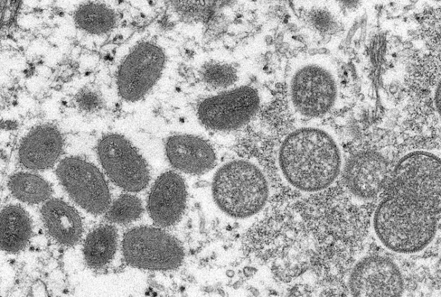 Paraíba chega a 61 casos suspeitos de varíola dos macacos
