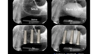 Maxillary Sinus Lift