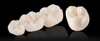 Nên biết răng sứ Zirconia là gì?