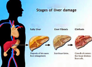 Liver Cancer Symptoms