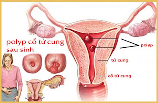 triệu chứng polyp cổ tử cung sau sinh