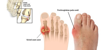 Makanan Penyebab Asam Urat Meningkat