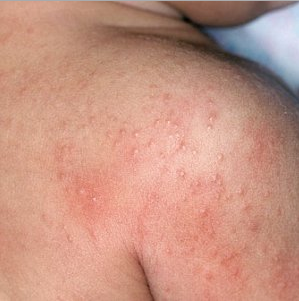 Bintik Yang Terasa Gatal Di Lengan Dan Kaki Karena Molluscum Contagiosum (Infeksi Virus) 