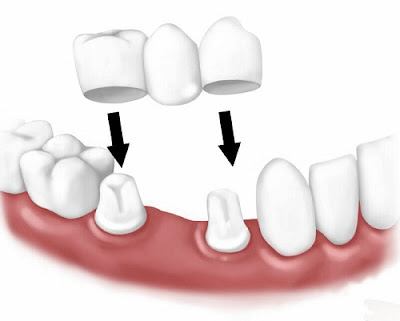 Các loại cầu răng sứ hiện nay